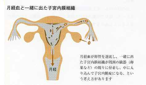 子宮内膜症と不妊　図②